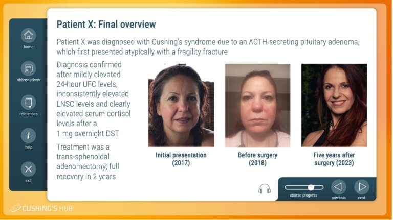 case study 77 cushing syndrome